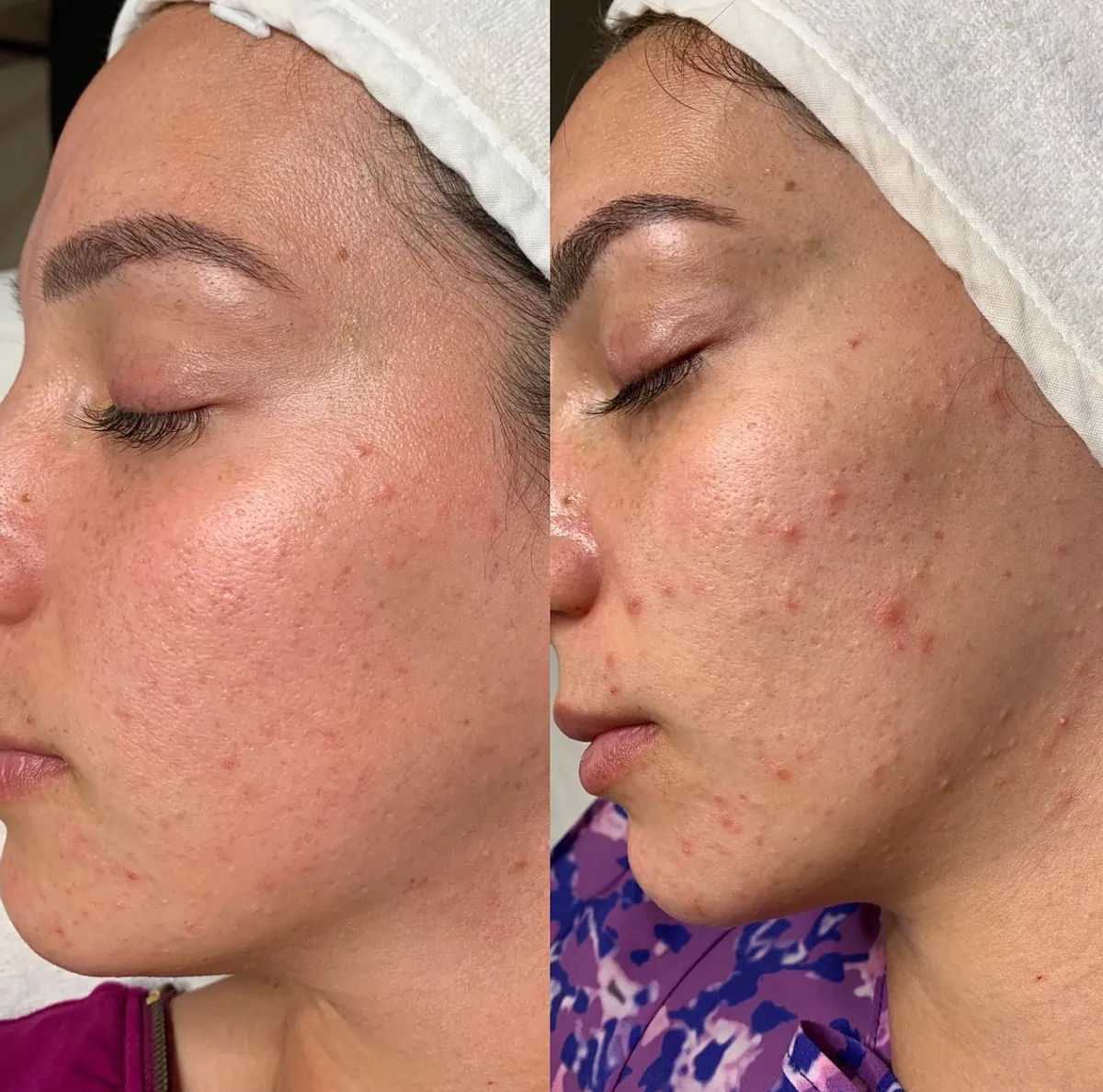 Antes y después — tratamiento de acné, CS Beauty